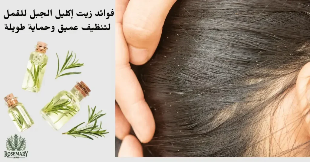 فوائد زيت إكليل الجبل في التخلص من القمل